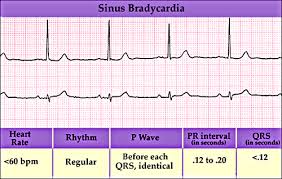 slow heartbeat