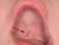 submucous cleft palate