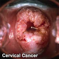 uterus cancer