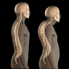 osteoporosis