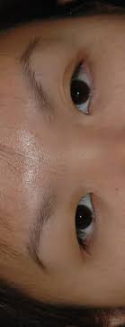 eyelid droop