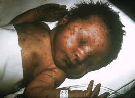 viral infections
