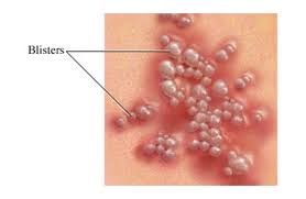 viral infections
