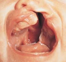 submucous cleft palate
