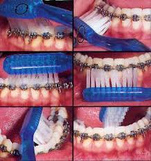 flossing braces