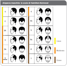 alopecia androgenetica