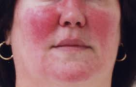 dietary rosacea