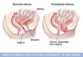 fallen uterus