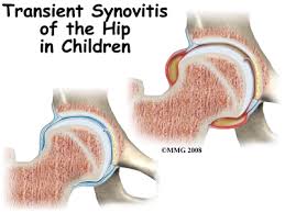 villonodular synovitis and symptoms