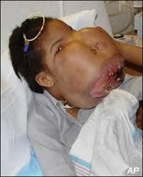 nose reconstruction