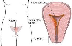 uterus cancer