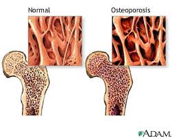 osteoporosis