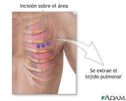 incisiones quirurgicas