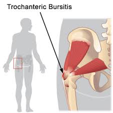 bursitis hip