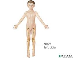 perthes disease