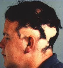 alopecia eyebrows