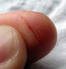 finger cut