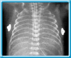 transient tachypnea of the newborn