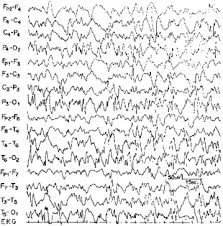 eeg patterns