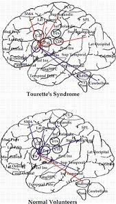 tourette syndrome