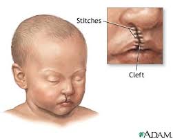cleft lip palate