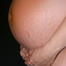 stretchmarks