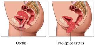 fallen uterus