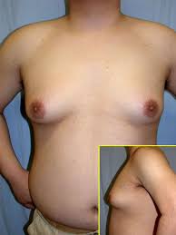 gynecomastia