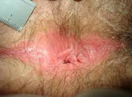 anorectal bleeding
