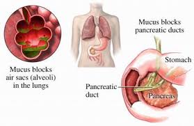 Cystic fibrosis - Medicalook