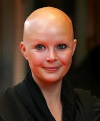 alopecia women