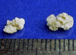kidney stones Photos and a