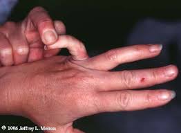 Ehlers-Danlos syndrome