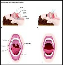 soft palate