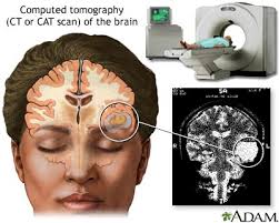 migraine symptoms