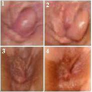 hemorroid treatment