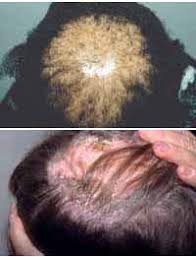 alopecia cicatricial