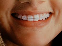 braces pictures