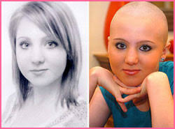 alopecia women