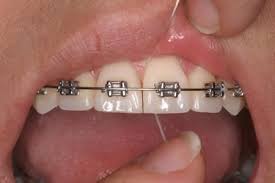 cepillado%252012 Utiliza el Hilo Dental