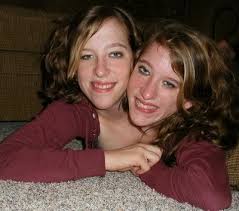 the siamese twins