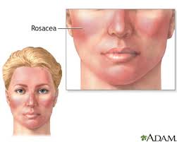dietary rosacea