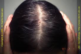 androgenetic alopecia