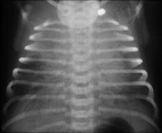 transient tachypnea of the newborn