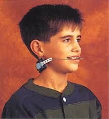braces pictures