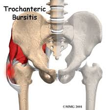 bursitis hip