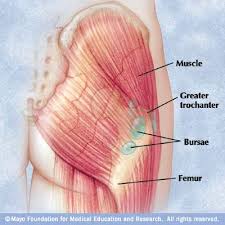 bursitis hip