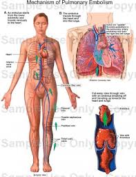 of Pulmonary Embolism