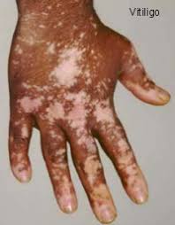 vitiligo on hand (277.jpg)