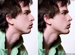 Rhinoplasty surgery is a